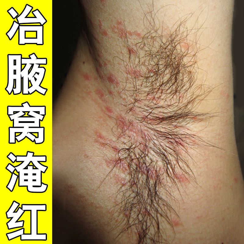 腋窝淹红腋下防淹有味胳肢窝出汗红肿疼痛痒摩擦淹了烂痒