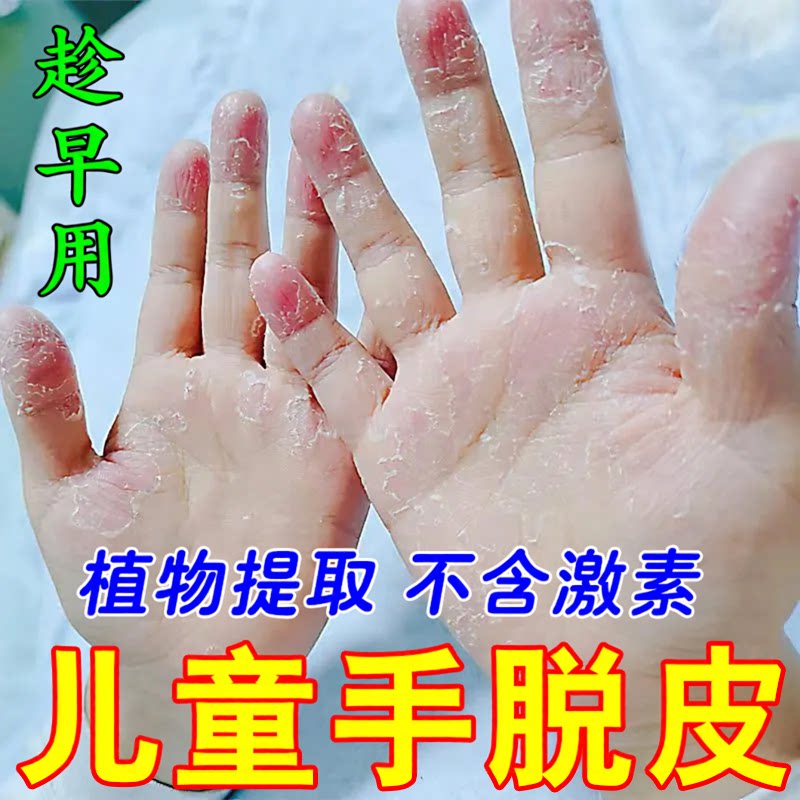 小孩手指头蜕皮严重手脱皮专用药膏儿童手脚上起皮干燥掉皮护手霜