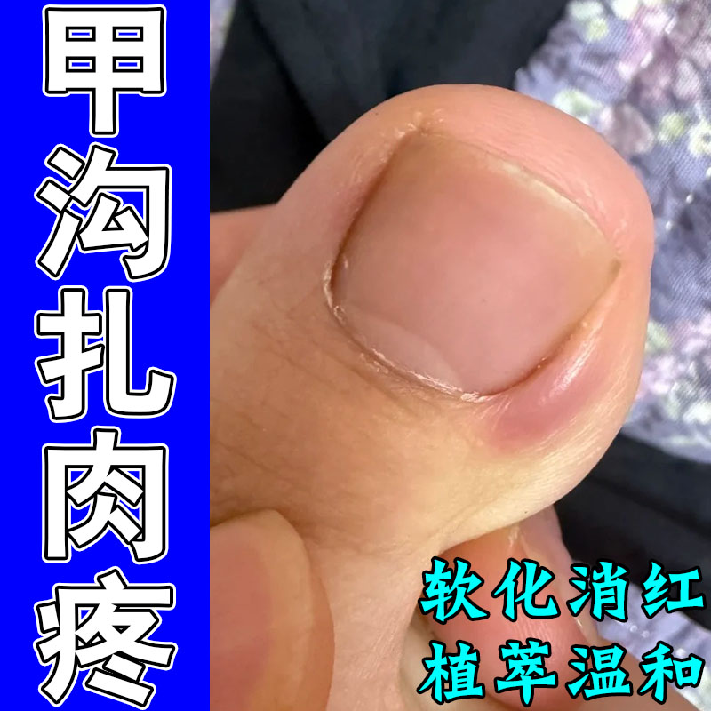 甲沟红肿疼息肉膏冶手脚指甲旁红肿发红肿大化脓痛草本修护膏