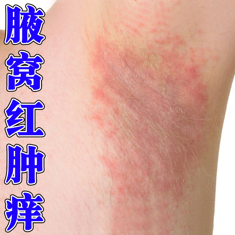腋窝淹红腋窝防淹湿热腋下痒出汗神器