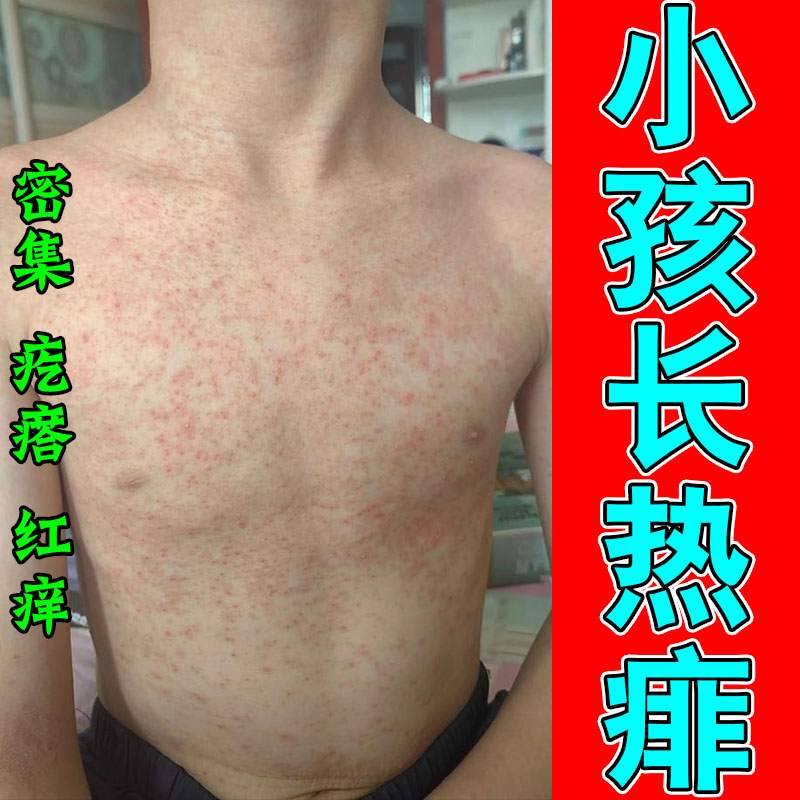 小孩痱子疙瘩红痒热痱痒小孩子身上热天热皮肤捂起疙瘩红痒喷剂