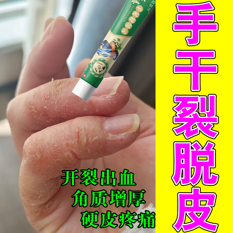 手裂口子干燥粗糙爆干皮缺水粗糙指缝指腹干燥开裂修护保湿膏