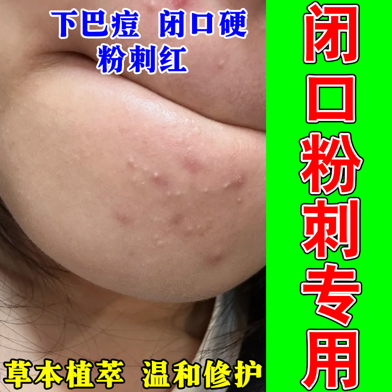 去闭口粉刺下巴脸部额头粉刺疙瘩多红肿疼密集疙瘩草本修护乳膏