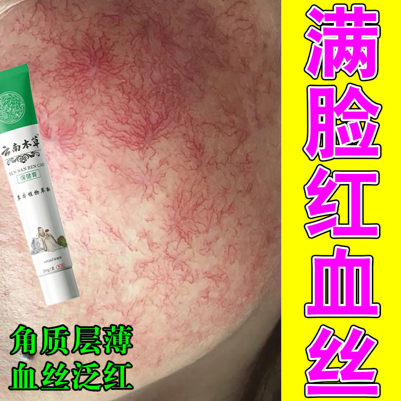 脸上红血丝过敏皮肤干燥粗糙脸部敏感脸颊泛红红血丝严重草本乳膏