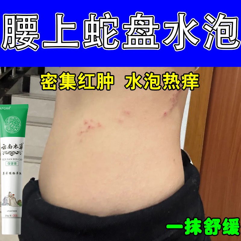 腰上长小疙瘩起泡小水红皮肤过敏真菌汗状泡皮肤红痛修护乳膏