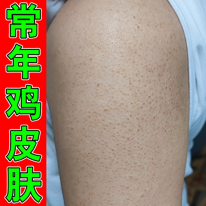 手臂腿上鸡皮疙瘩外用乳膏腿上疙瘩起小颗粒疙瘩摸起来粗糙
