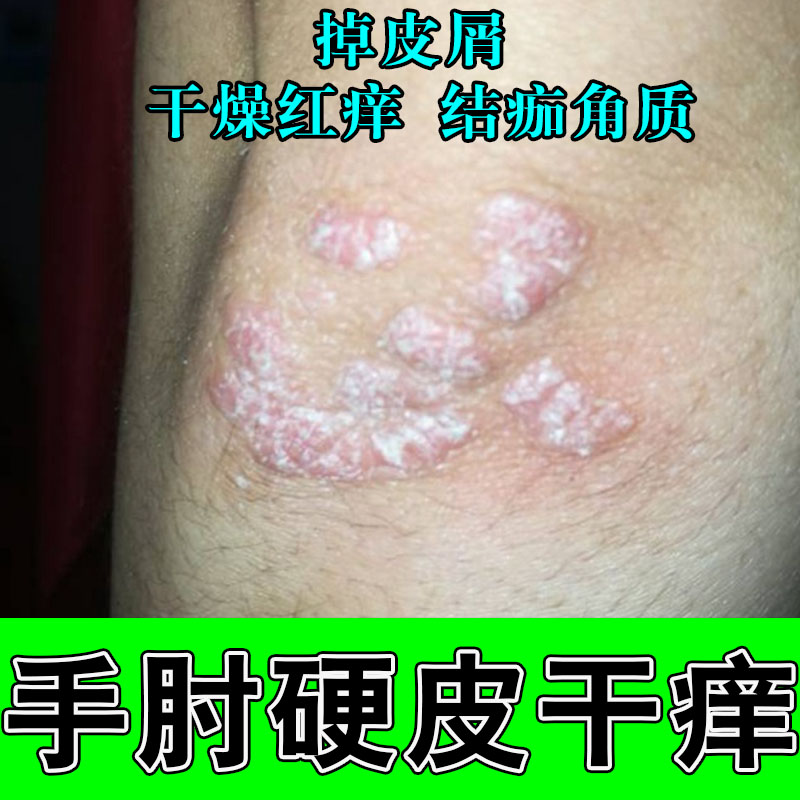 胳膊肘红屑胳膊肘关节发肤红干燥粗糙脱皮掉屑角质皮肤神经过敏痒