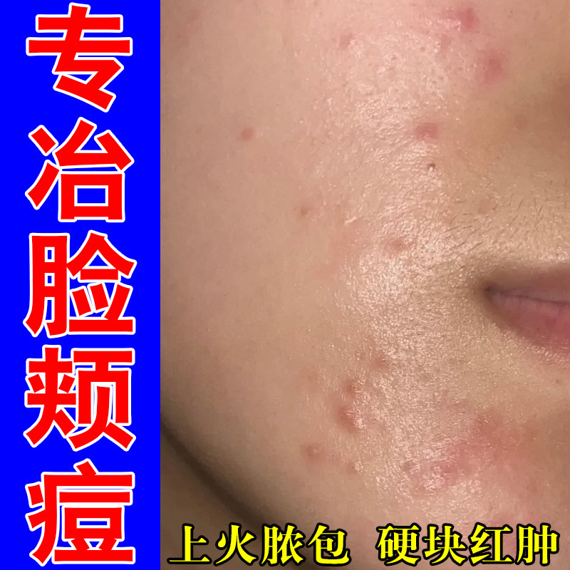 脸上长硬肿痘干皮泛红硬块修护成人粉刺疙瘩舒缓修护保湿乳霜