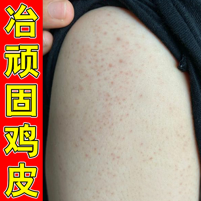 胳膊鸡皮疙瘩去除毛周角化手臂鸡皮去除毛囊角质