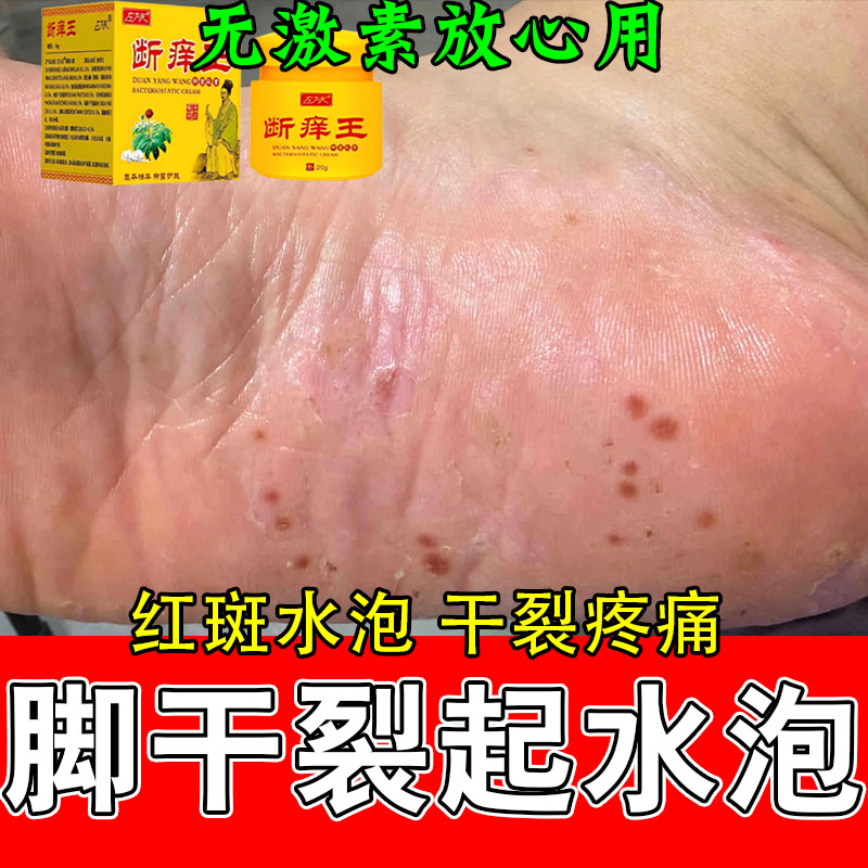 掌跖手脚干燥粗糙起皮干裂脱皮泛红开裂不适角质增厚外用软膏