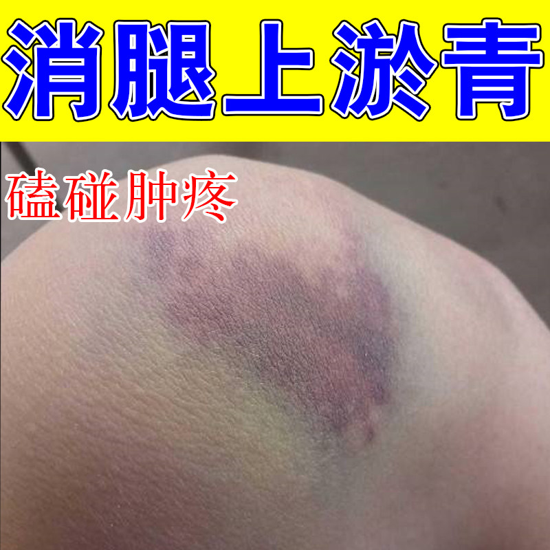 腿上撞伤淤青身上有瘀斑摔伤磕碰撞伤红肿发紫疼痛活血化瘀专用膏