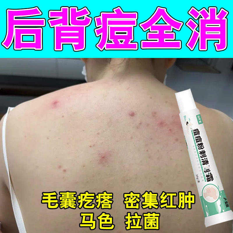 后背背上长痘毛囊痘疙瘩密集红痒皮肤粗糙疙瘩疼红草本修护软膏