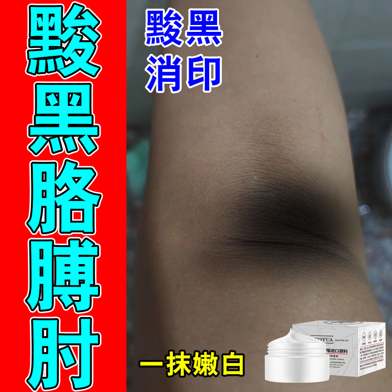 胳膊肘黑皮肤色素沉淀除黑皮角质手膝关节白嫩化按摩膏