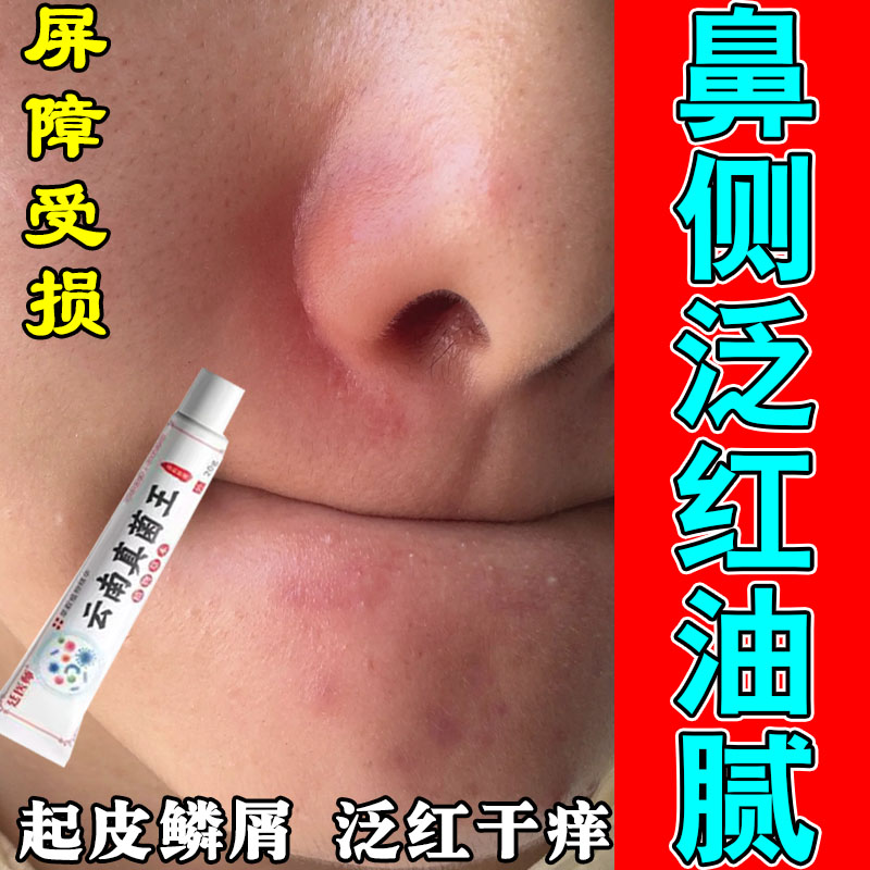 冶鼻子红痒脂溢性鼻发红起皮鼻翼两边泛红干燥掉皮红痒草本萃取膏