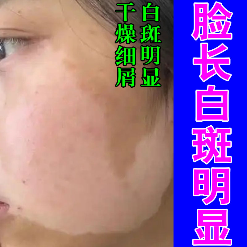 脸上长白斑成人童脸上有白色快速白斑小白块汗斑花斑膏乳