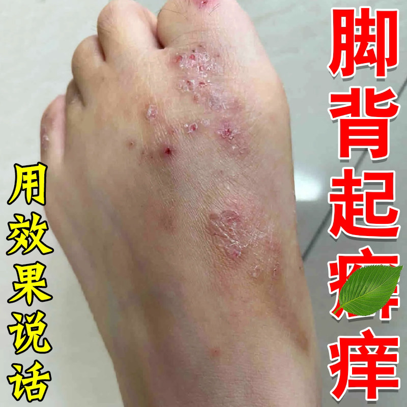 脚背脚面皮脚杆脚上红疙瘩痒粗糙干燥红点脚背红肿