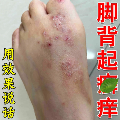 脚背发痒脚面皮脚杆痒脚上起红疙瘩红点脚背红肿