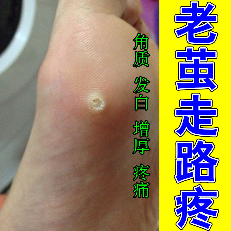 脚底脚钉老茧脚趾关节厚茧脚垫硬茧脚茧子修护软膏贴