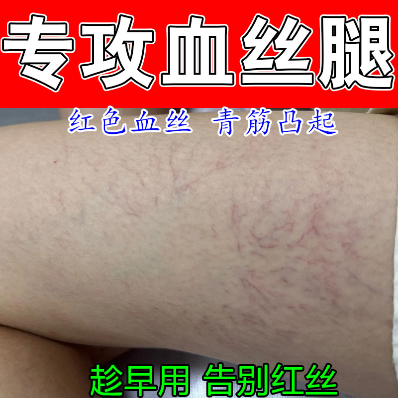 腿上红血丝严重红血丝青筋凸起血管扩张酸痛长红血丝草本修护乳膏