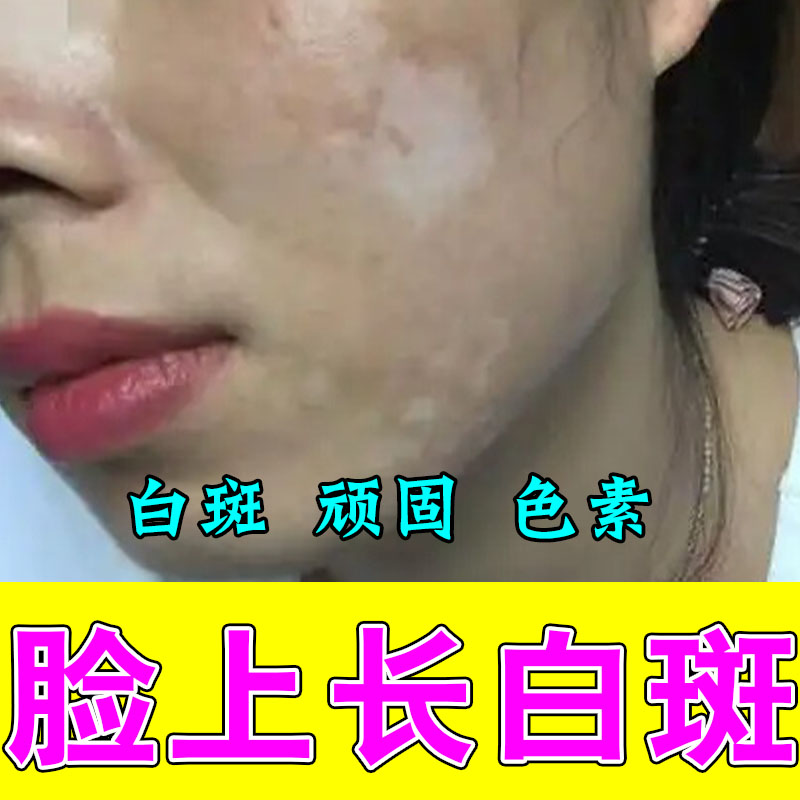 脸上长白斑白块成人童脸上有小白点快速汗斑花斑白色膏乳