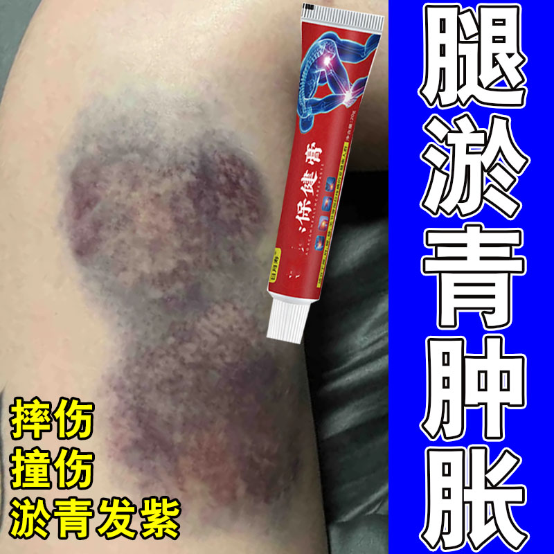 去发紫腿部淤青活血化瘀全身腿上摔磕撞伤发青紫消肿痛专用膏