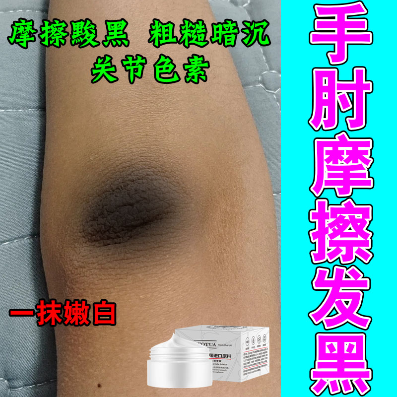 去胳膊肘黑皮肤脖子黑色素沉淀手肘关节黑棘皮角质按摩膏