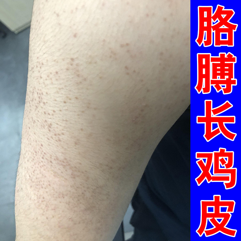胳膊上起小疙瘩手臂毛囊长痘鸡皮去除毛囊角化角质专用膏