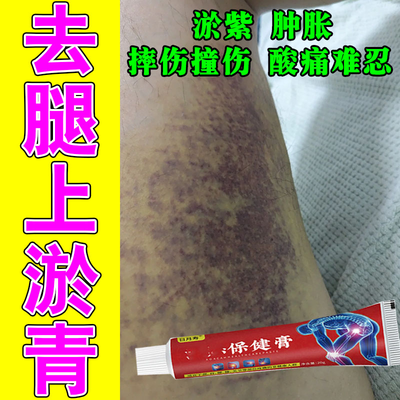 去摔伤腿上淤青活血化瘀全身腿上摔磕撞伤发青紫消肿痛专用修护膏