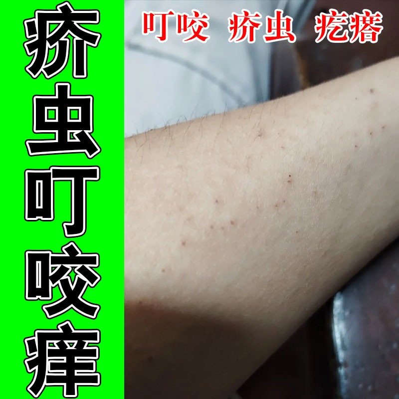 腿上腿部红痒水泡螨虫浑身痒疙瘩结痂植物萃取草本软膏