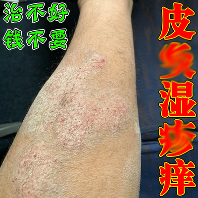 去哏除外用顽固无激素皮肤病膏祛