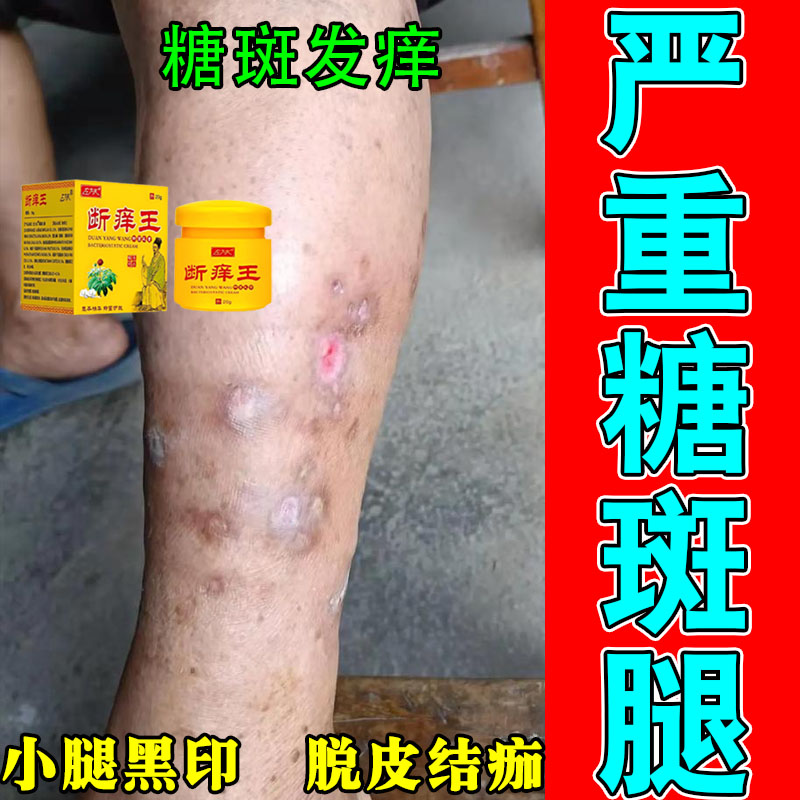 老人小腿足部肌肤干痒疙瘩糖化形成褐色大块斑皮肤发痒涂抹植物膏
