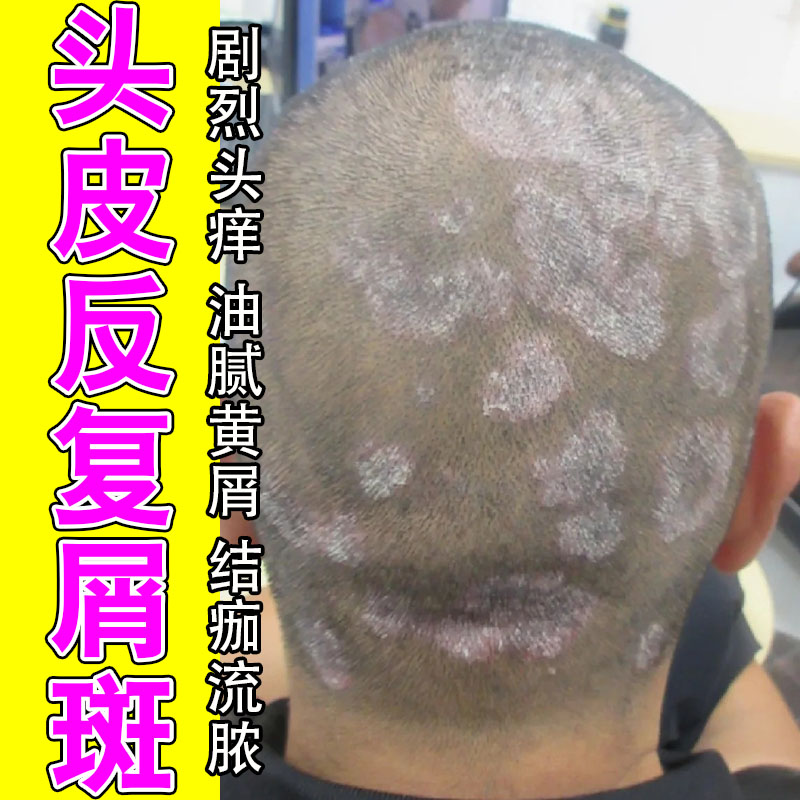 冶头皮干屑痒脱屑泛红结痂头痒不适红肿结痂头白色鳞屑干燥修护膏