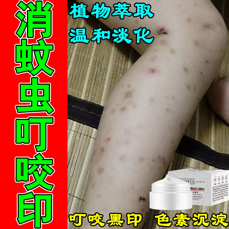 去蚊子叮发痒抓挠暗沉黑斑明显深色黑印全身适用积雪草按摩膏