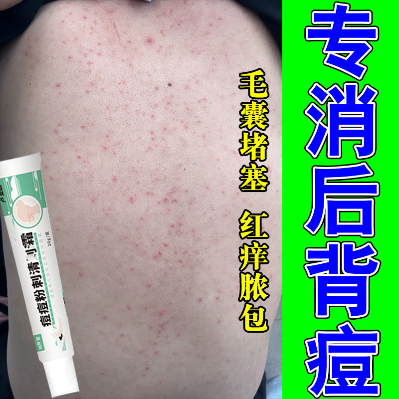 后背马拉色菌毛囊背上长痘皮肤毛囊不适粗糙痒真菌疙瘩修护软膏