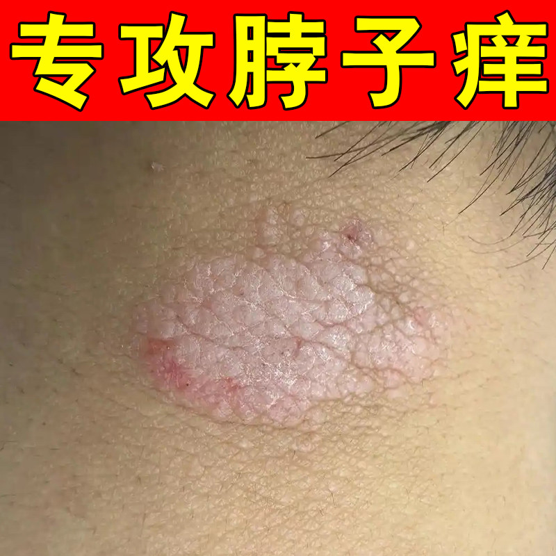 脖子上皮肤起疙瘩泛红外用膏身上干燥刺挠痒起皮