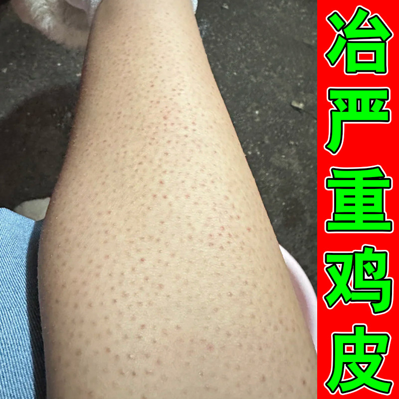 去除腿上手臂鸡皮密麻小疙瘩毛囊堵塞粗糙去鸡皮神器