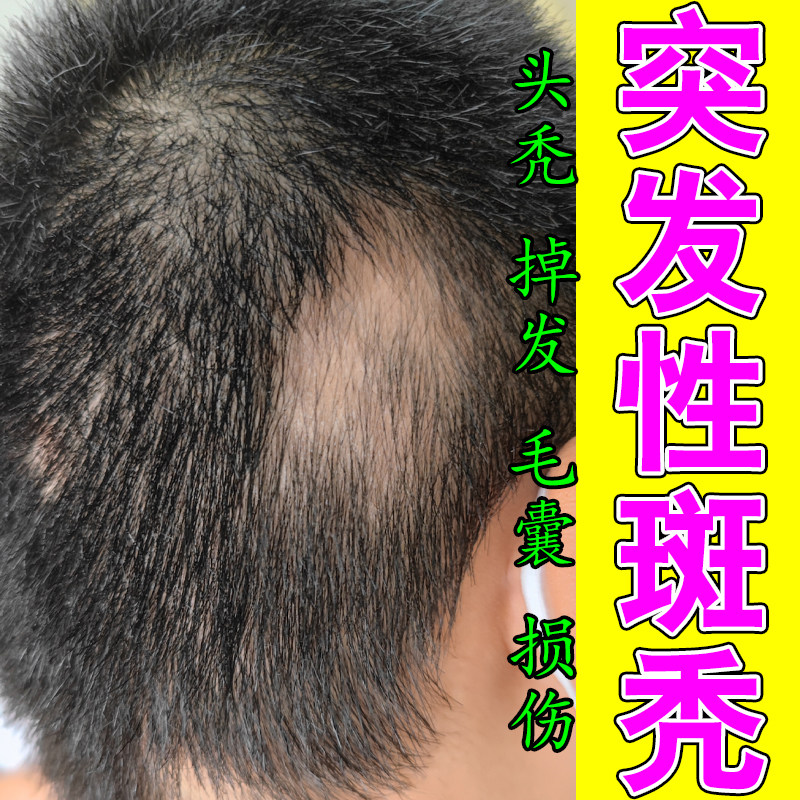 头顶毛囊受损大面积脱发修护毛囊生发护发露头皮草本修护深层喷剂