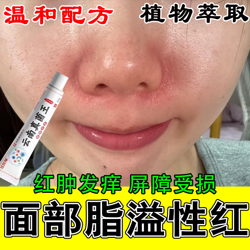 脂溢性鼻侧泛红干痒粗糙起干皮掉皮屑鼻子两边发红痒修复保湿软膏