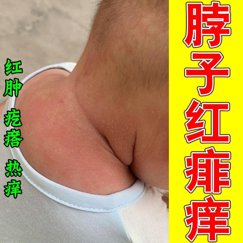 天气热痱子热疙瘩痱痒大人后背起红疙瘩红皮肤痒植物喷剂