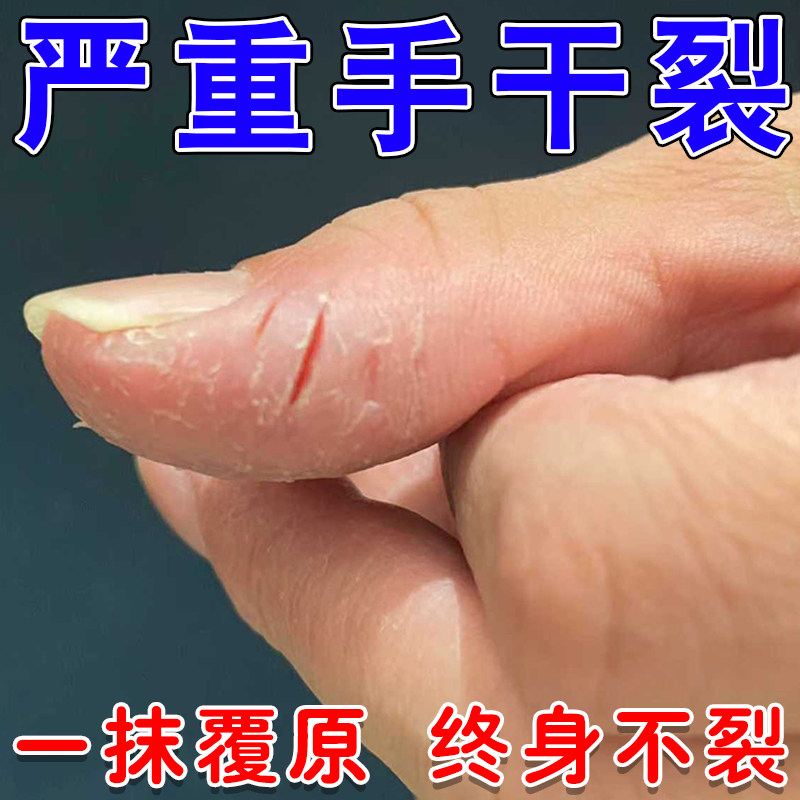 手裂口干裂修复霜秋冬季指甲缝干裂口蜕皮脚趾指头裂口子