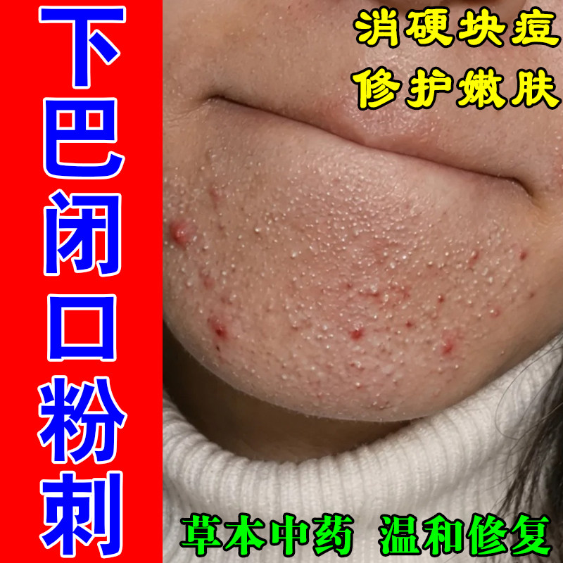 下巴长膏乳脸上红肿硬块包内分泌失调熬夜上火闭口粉刺修复膏