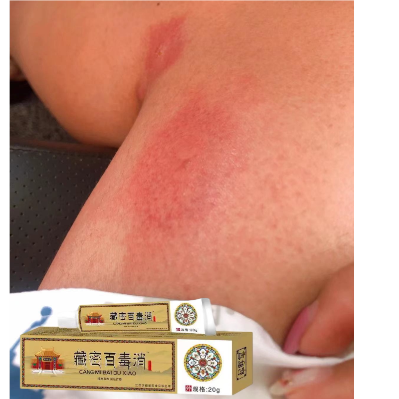 皮肤蚊虫臭虫痒药膏瘙痒叮咬蚊叮虫咬止痒消包止痒蚊虫
