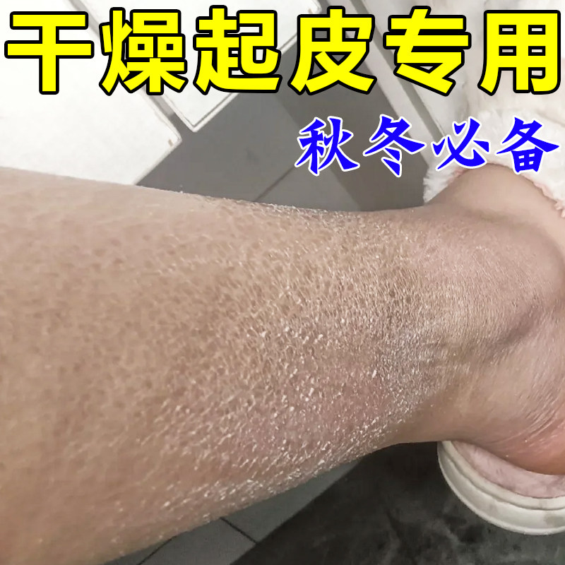 腿上干燥起皮小腿皮肤刺挠冬天起身体乳/霜