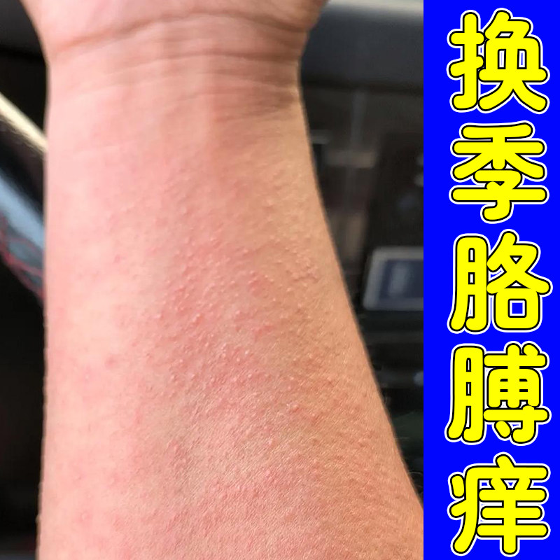 手臂皮肤发痒春季身上起红疙瘩长小红点刺挠全身痒外用