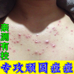 身上起红疙瘩长小红点前胸后背长痘发痒用