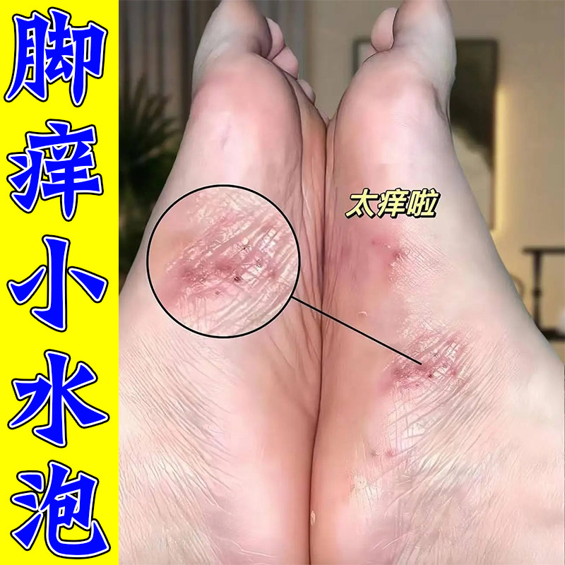脚底长小水泡脚趾缝糜烂痒脚痒脚底臭皮肤越抓越痒外用膏