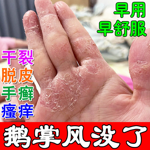 手鲜膏脱皮干裂手上手痒膏