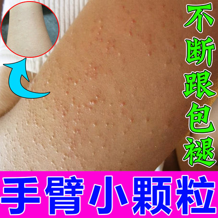胳膊上长小疙瘩毛囊堵塞密麻颗粒粗糙用