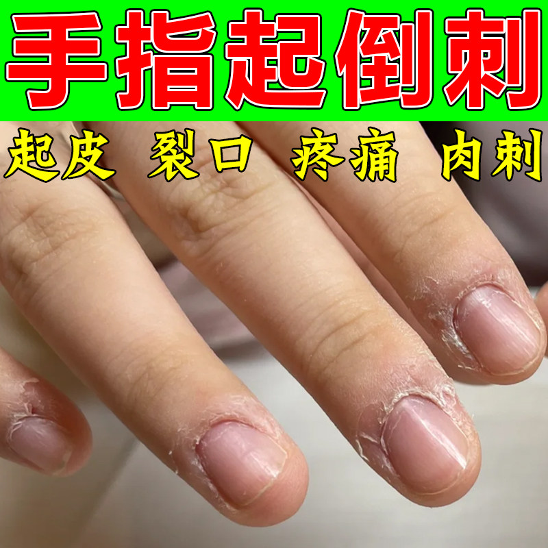儿童指甲边缘长倒刺软膏去肉刺死皮手指甲边缘表皮撕裂脱皮