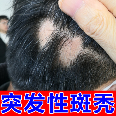 鬼剃头斑秃产后头顶掉发头发增长液增密防脱发毛囊精华